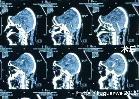 颅内感染的治疗化脓性脑室炎后孤立性第四脑室案例(转载)