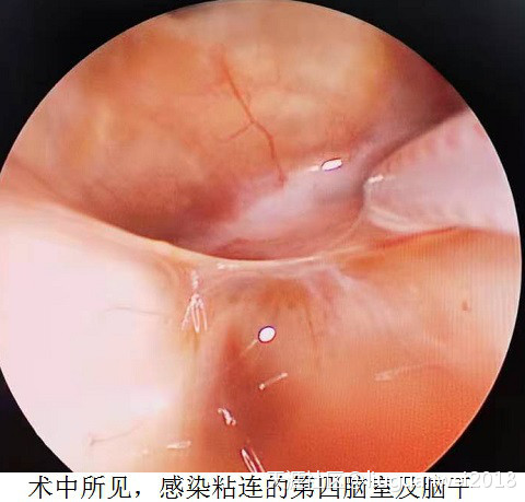 颅内感染的治疗化脓性脑室炎后孤立性第四脑室案例(转载)