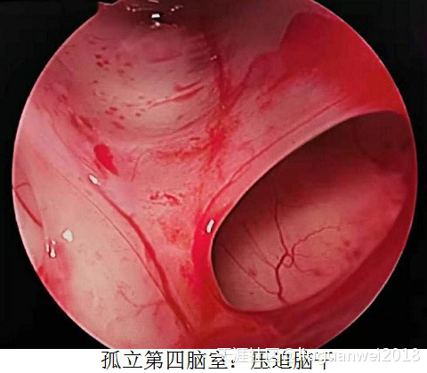 颅内感染的治疗化脓性脑室炎后孤立性第四脑室案例(转载)