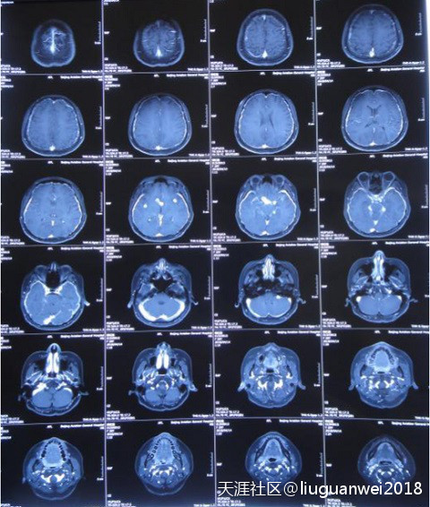 颅内多发结核脓肿、结核性脑膜炎、脑积水患者康复病例(转载)