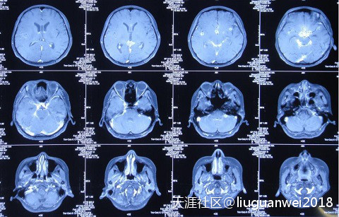 颅内多发结核脓肿、结核性脑膜炎、脑积水患者康复病例(转载)