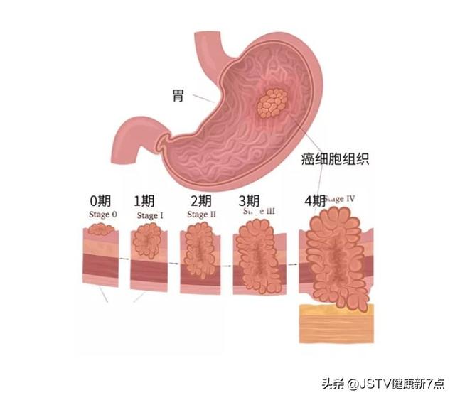 胃癌的症状、诊断、治疗，你该知道的都在这里