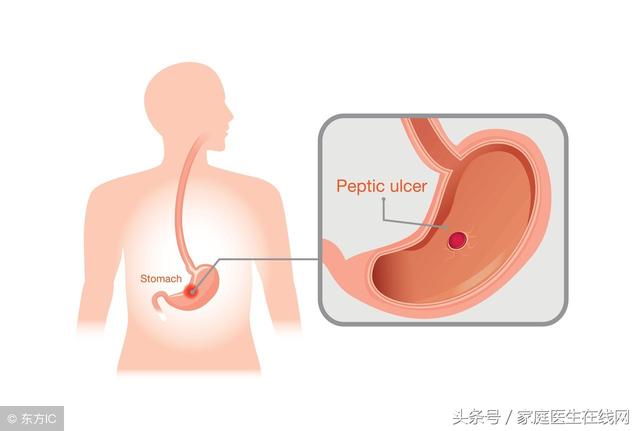 越来越多人得胃癌？目前治疗胃癌，多靠这2类方法