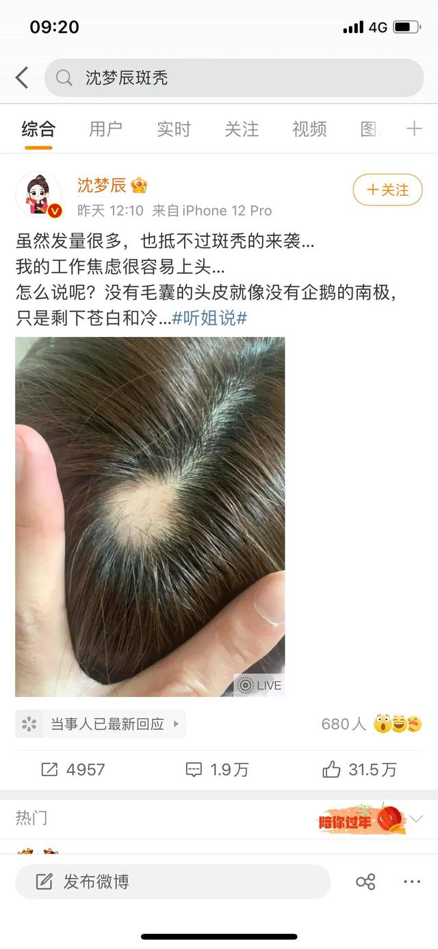 沈梦辰的斑秃照为什么会上热搜？