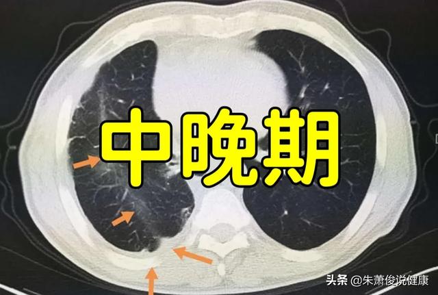 癌细胞浸润是什么意思？