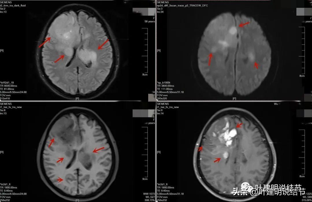 水玻璃密度_黑色玻璃陨石密度_肺部玻璃密度结节